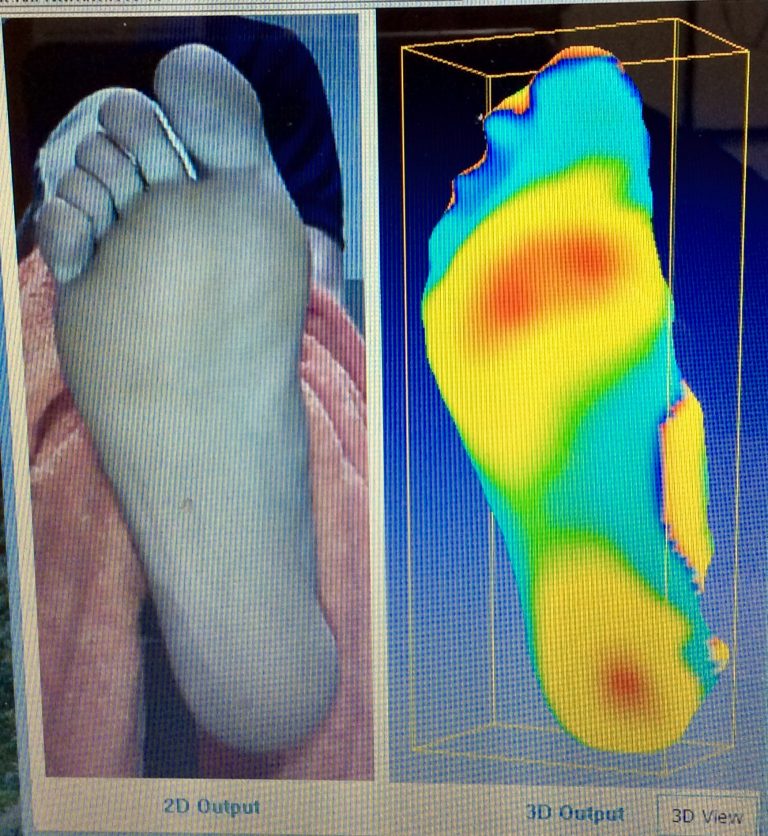 Customised Foot Orthotics. Riddells Creek & Sunbury Podiatry Clinics.